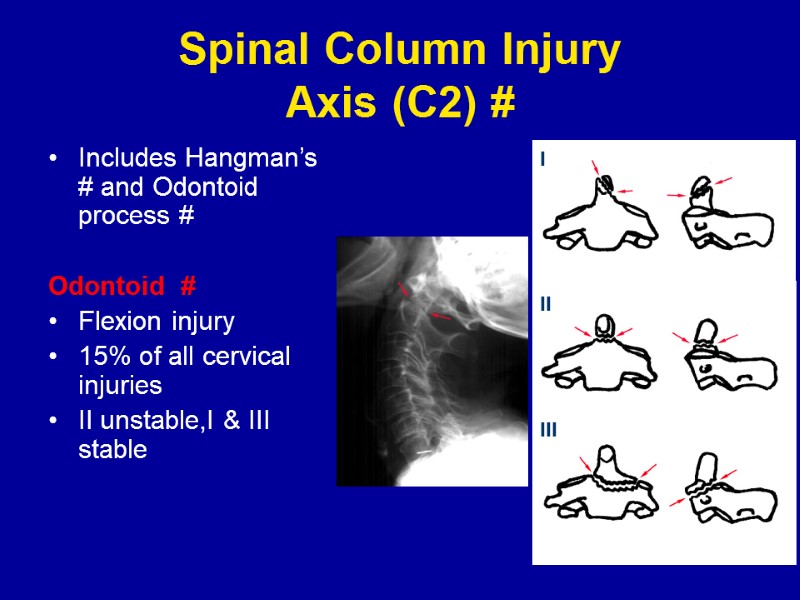 Spinal Column Injury Axis (C2) # Includes Hangman’s # and Odontoid process # 